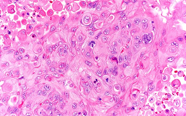 99A Metastasis, lung, squamous (Case 99) H&E 40X