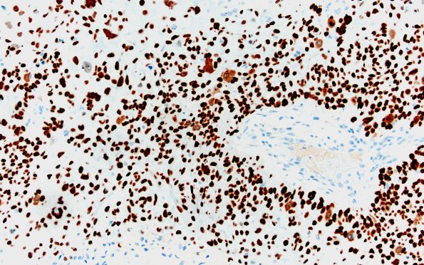 99B Metastasis, lung, squamous (Case 99) p40 20X