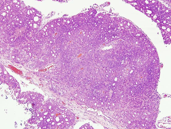 9A1 Metastasis, prostate (Case 9) H&E 10X