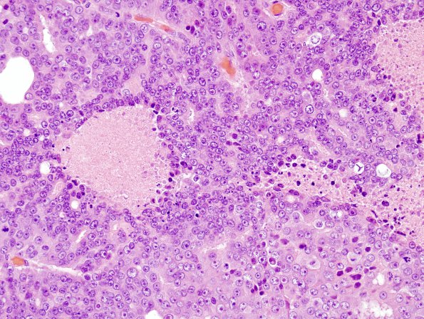 9A2 Metastasis, prostate (Case 9) H&E 1