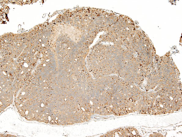 9B1 Metastasis, prostate (Case 9) Prostein 10X