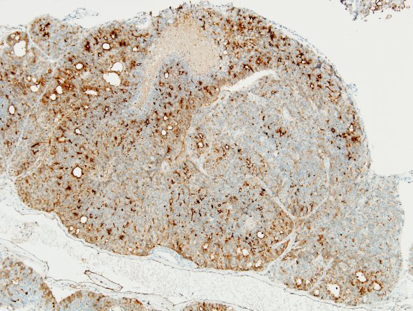 9C1 Metastasis, prostate (Case 9) PSA 10X