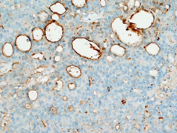 9D2 Metastasis, prostate (Case 9) PSAP 40X