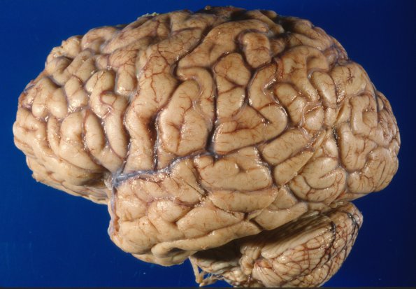 1A1 Metastasis, single case (Case 1)