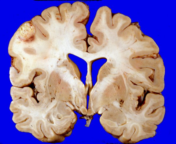 1A2 Metastases, Lung primary (Case 1) a