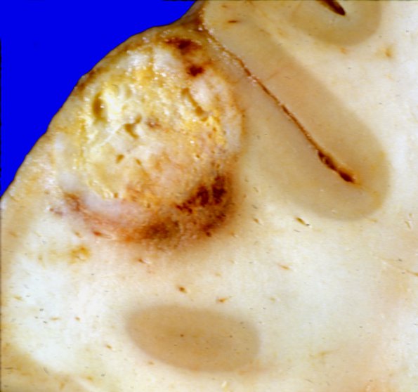 1A3 Metastases Lung primary (Case 1) c