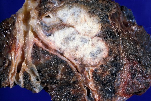 1A4 Metastases (Case 1) Lung primary 1