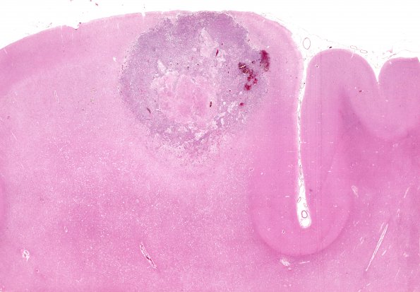 1B1 Metastases, (Case 1) H&E whole mount