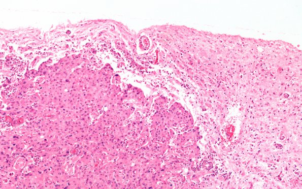 1B2 Metastases (Case 1) G H&E 10X 4