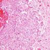 1B4 Metastases (Case 1) G H&E 10X 3