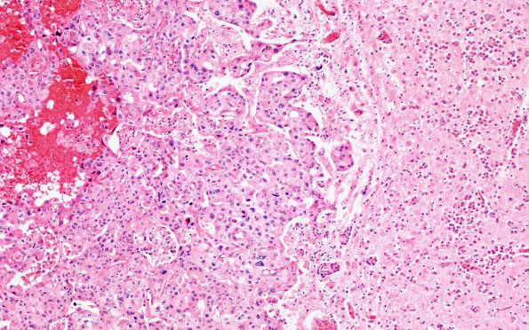 1B4 Metastases (Case 1) G H&E 10X 3