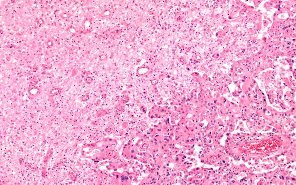 1B5 Metastases (Case 1) G H&E 10X 1