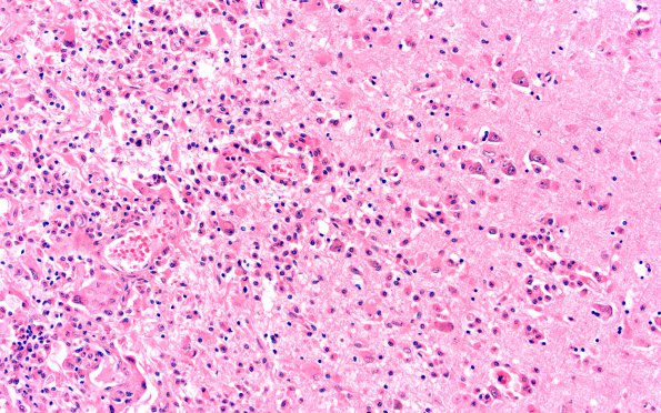 1B7 Metastases (Case 1) G H&E 20X 3