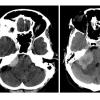 1A1 Meningioma with SCLC metastasis (Case 1) CT scan - Copy