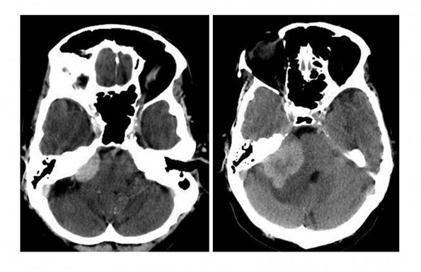 1A1 Meningioma with SCLC metastasis (Case 1) CT scan - Copy