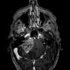 1A2 Meningioma with SCLC metastasis (Case 1) T1W - Copy