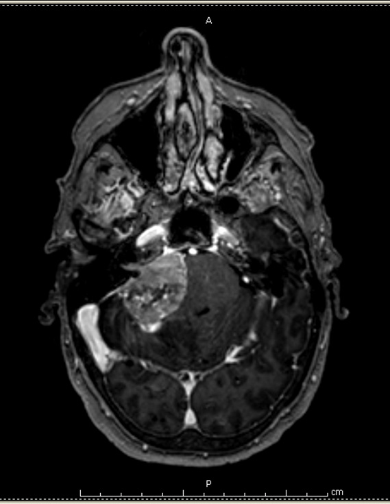 1A2 Meningioma with SCLC metastasis (Case 1) T1W - Copy