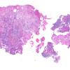 1B1 Meningioma with SCLC metastasis (Case 1) H&E WM