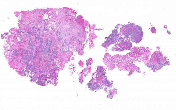 1B1 Meningioma with SCLC metastasis (Case 1) H&E WM