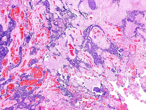 1B2 Meningioma with SCLC metastasis (Case 1) H&E 1