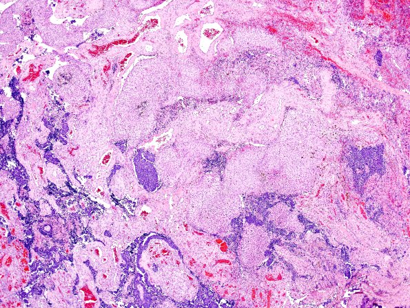 1B3 Meningioma with SCLC metastasis (Case 1) H&E 2