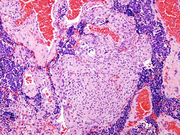 1B4 Meningioma with SCLC metastasis (Case 1) H&E 9