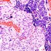 1B5 Meningioma with SCLC metastasis (Case 1) H&E 10