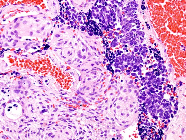 1B5 Meningioma with SCLC metastasis (Case 1) H&E 10