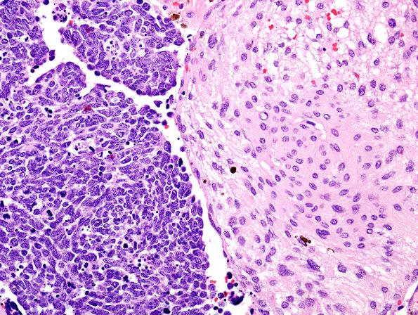 1B6 Meningioma with SCLC metastasis (Case 1) H&E 14