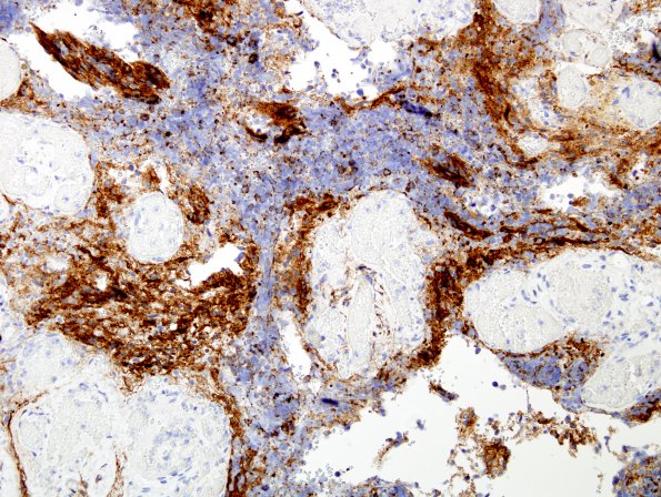 1C2 Meningioma with SCLC metastasis (Case 1) EMA 7