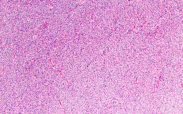 10A1 Central Liponeurocytoma (Case 10) H&E 10X