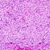 10A2 Liponeurocytoma, cerebellar (Case 10) H&E 46.jpg