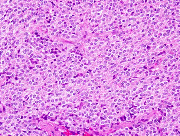 10A2 Liponeurocytoma, cerebellar (Case 10) H&E 46.jpg