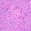 10A3 Liponeurocytoma, cerebellar (Case 10) H&E 47.jpg