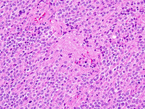 10A3 Liponeurocytoma, cerebellar (Case 10) H&E 47.jpg