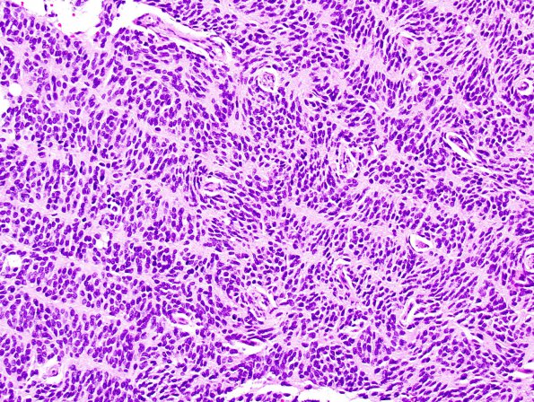 10A4 Liponeurocytoma, cerebellar (Case 10) H&E 49.jpg