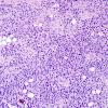 10A5 Liponeurocytoma, cerebellar (Case 10) H&E 10.jpg