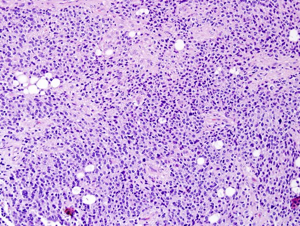 10A5 Liponeurocytoma, cerebellar (Case 10) H&E 10.jpg