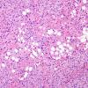 10A6 Liponeurocytoma, cerebellar (Case 10) 55