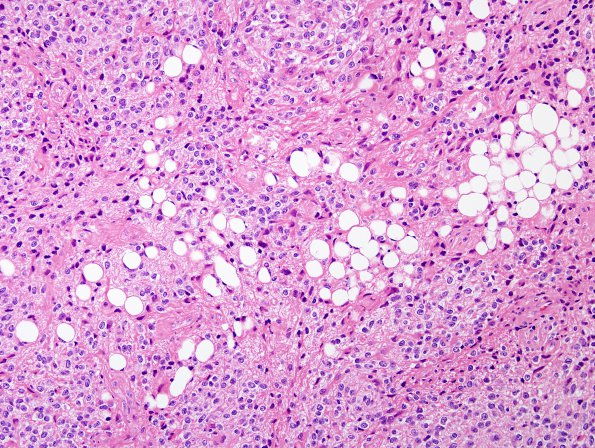 10A6 Liponeurocytoma, cerebellar (Case 10) 55