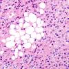 10A7 Liponeurocytoma, cerebellar (Case 10) 54