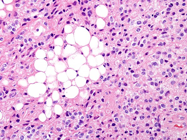 10A7 Liponeurocytoma, cerebellar (Case 10) 54