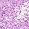 10A8 Liponeurocytoma, cerebellar (Case 10) H&E 37.jpg