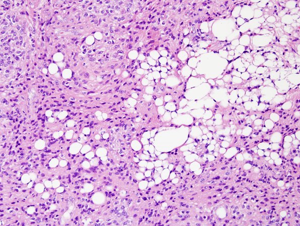 10A8 Liponeurocytoma, cerebellar (Case 10) H&E 37.jpg