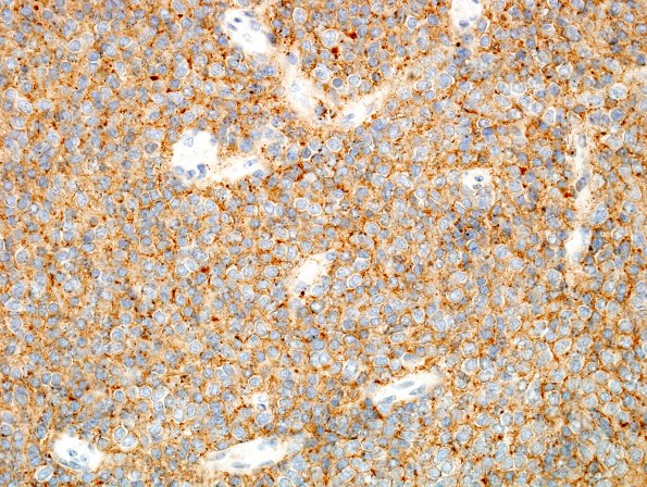 10B1 Liponeurocytoma, cerebellar (Case 10) SYN 4.jpg