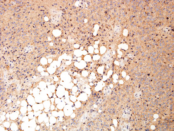 10B3 Liponeurocytoma, cerebellar (Case 10) SYN 5.jpg