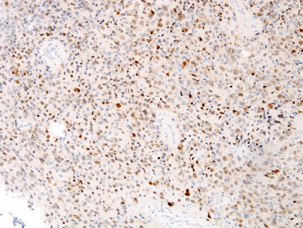 10C1 Liponeurocytoma, cerebellar (Case 10) NeuN 4.jpg