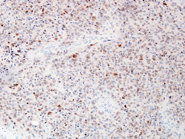 10C2 Liponeurocytoma, cerebellar (Case 10) NeuN 3.jpg