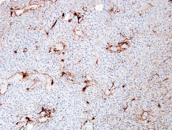 10D1 Liponeurocytoma, cerebellar (Case 10) GFAP 4.jpg