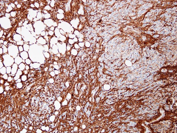 10D2 Liponeurocytoma, cerebellar (Case 10) GFAP 2.jpg